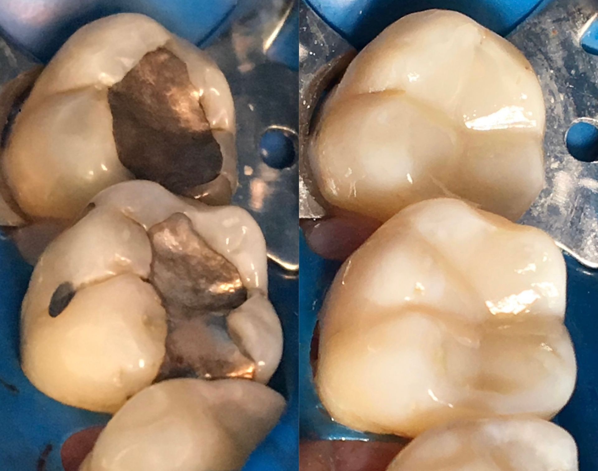 Composite White Filling