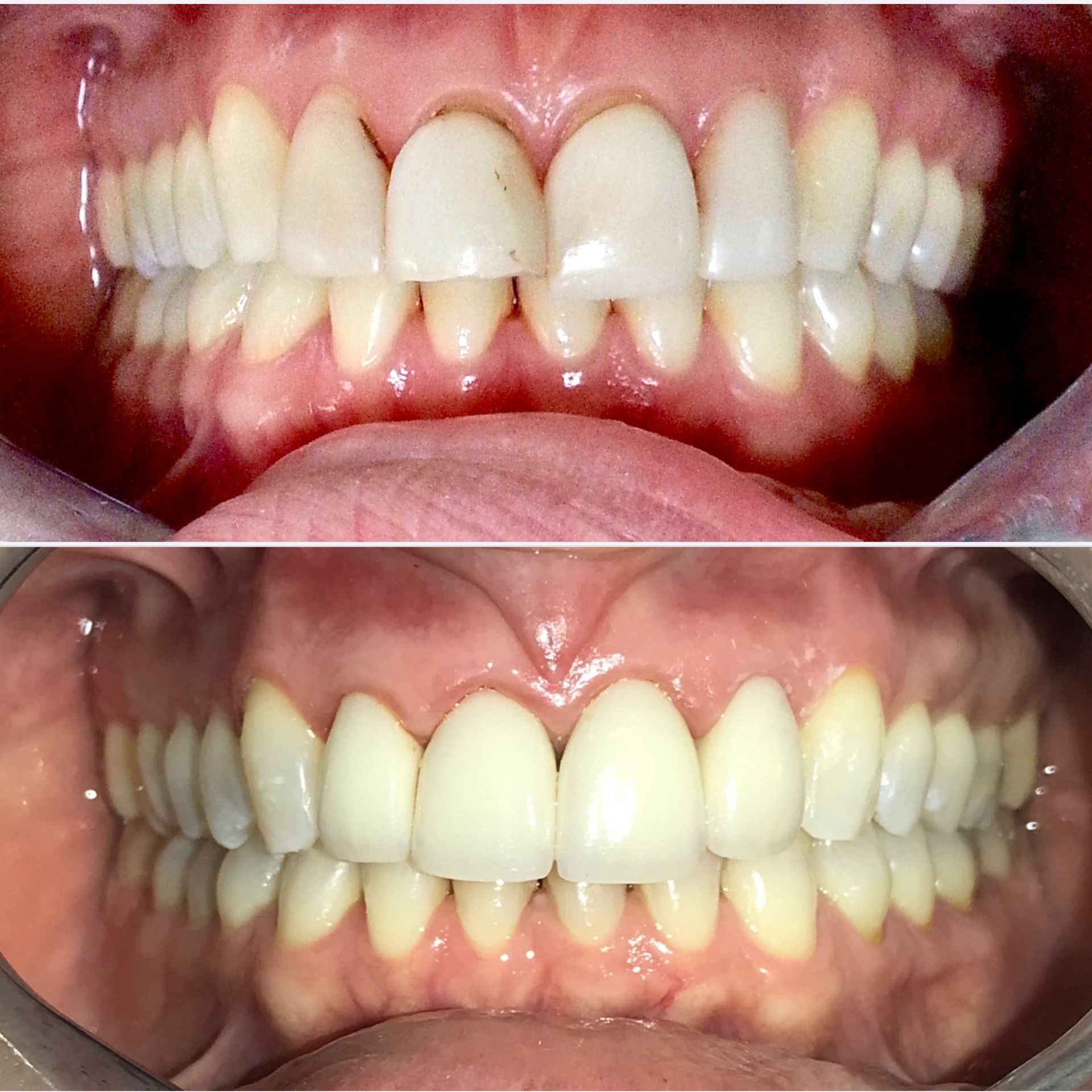 Zirconium Crown